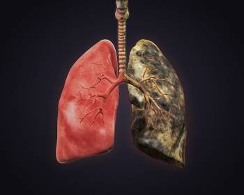 Lung Cancer - 5 things you need to know