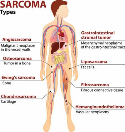 aggressive cancer of the soft tissue